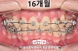 수술후