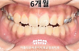 수술후
