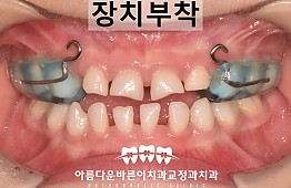 수술후