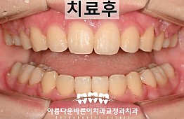 수술후