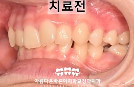 수술전