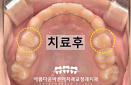 수술후