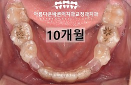 수술후