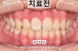 수술전