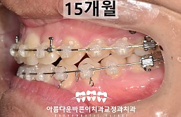 수술후