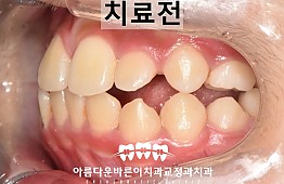 수술전
