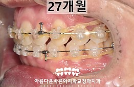 수술후