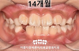 수술후