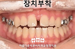 수술후