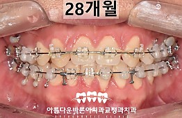 수술후