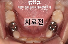 수술전