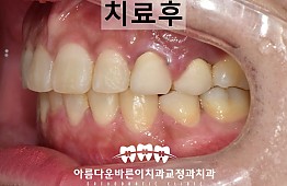 수술후